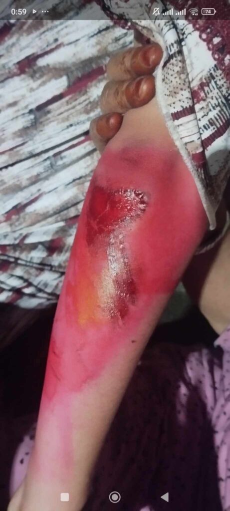 بعد مطاردة طفلة وإصابتها.. سكان حي الزيدانية يطالبون بتدخل عاجل