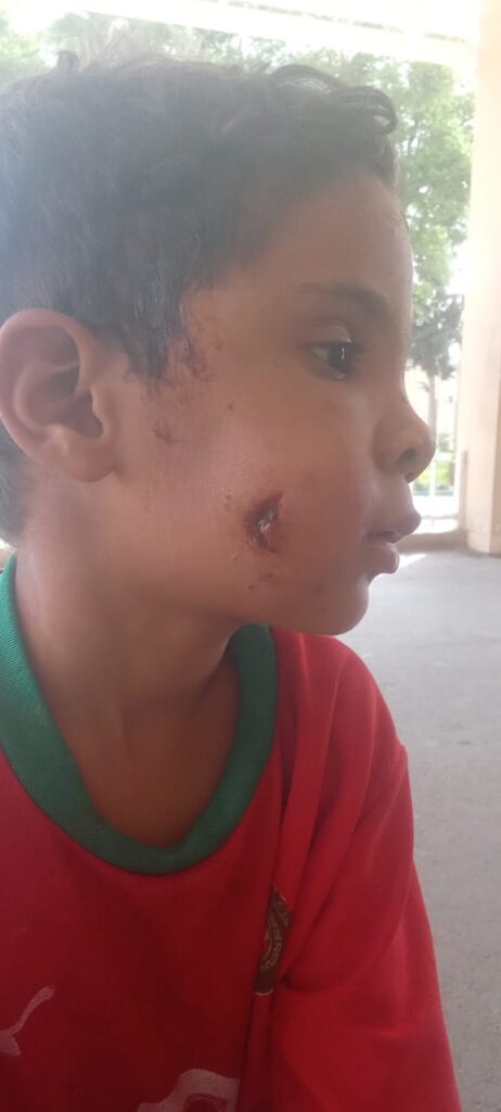 أحمر الكلالشة.. كلب ضال يهاجم طفلاً ويصيبه بجروح خطيرة على مستوى الوجه والعين